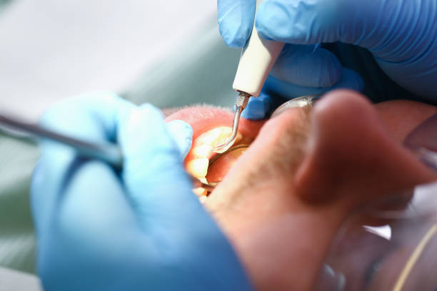 Best Emergency Tooth Extraction in Ritzville, WA